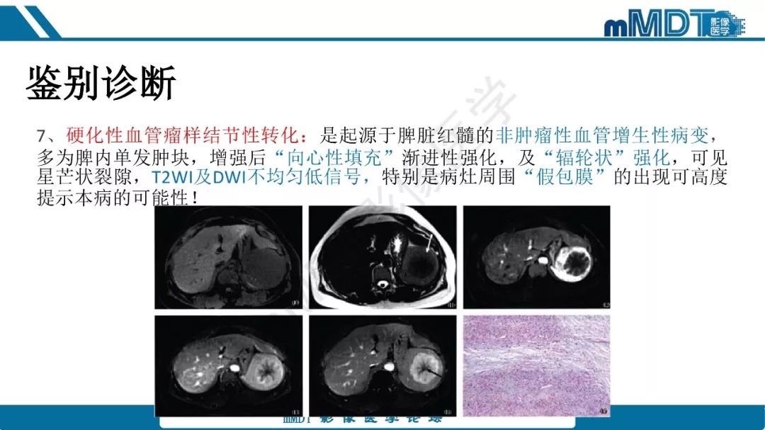 【病例】脾脏错构瘤1例病例解析