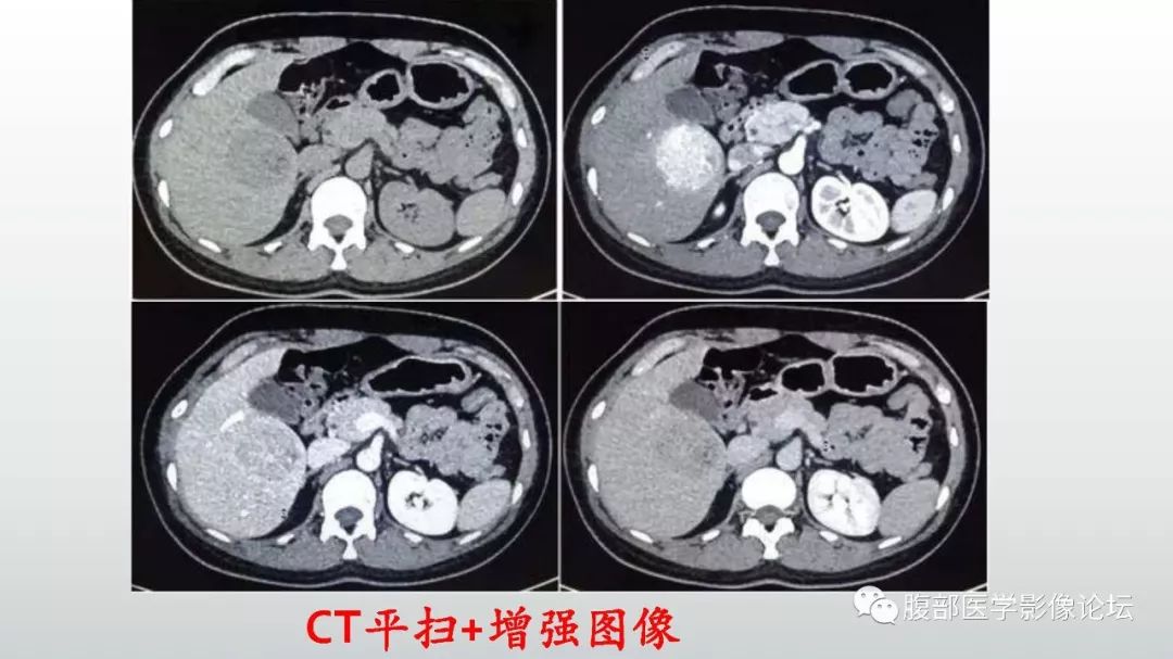 【病例】肝脏血管平滑肌脂肪瘤1例CT及MR影像诊断