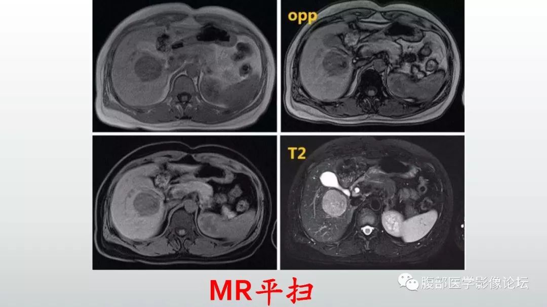【病例】肝脏血管平滑肌脂肪瘤1例CT及MR影像诊断