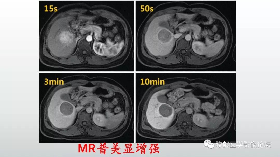 【病例】肝脏血管平滑肌脂肪瘤1例CT及MR影像诊断