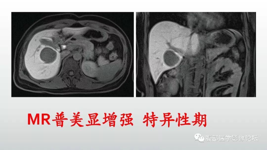 【病例】肝脏血管平滑肌脂肪瘤1例CT及MR影像诊断