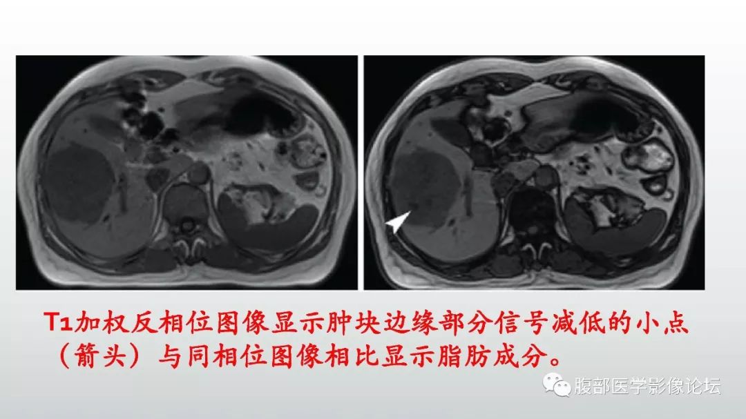 【病例】肝脏血管平滑肌脂肪瘤1例CT及MR影像诊断