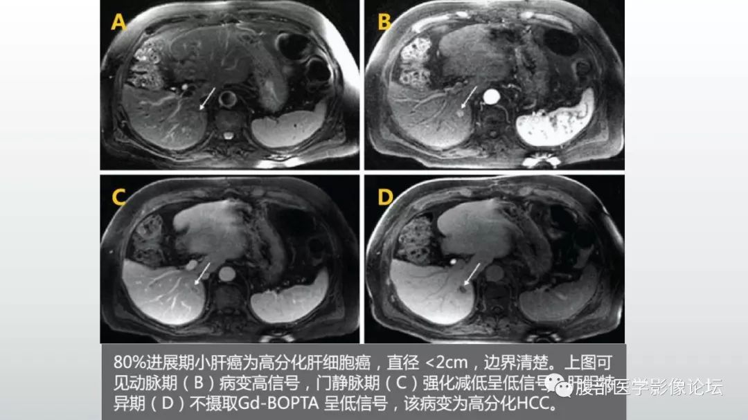 【病例】肝脏血管平滑肌脂肪瘤1例CT及MR影像诊断