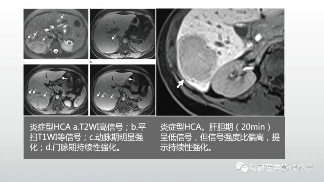 【病例】肝脏血管平滑肌脂肪瘤1例CT及MR影像诊断