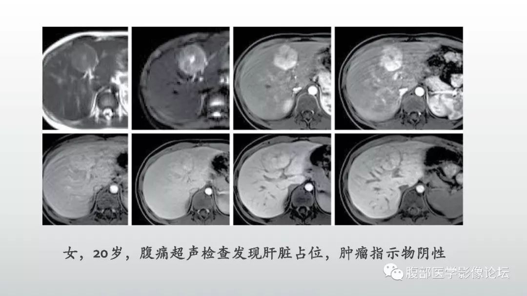 【病例】肝脏血管平滑肌脂肪瘤1例CT及MR影像诊断