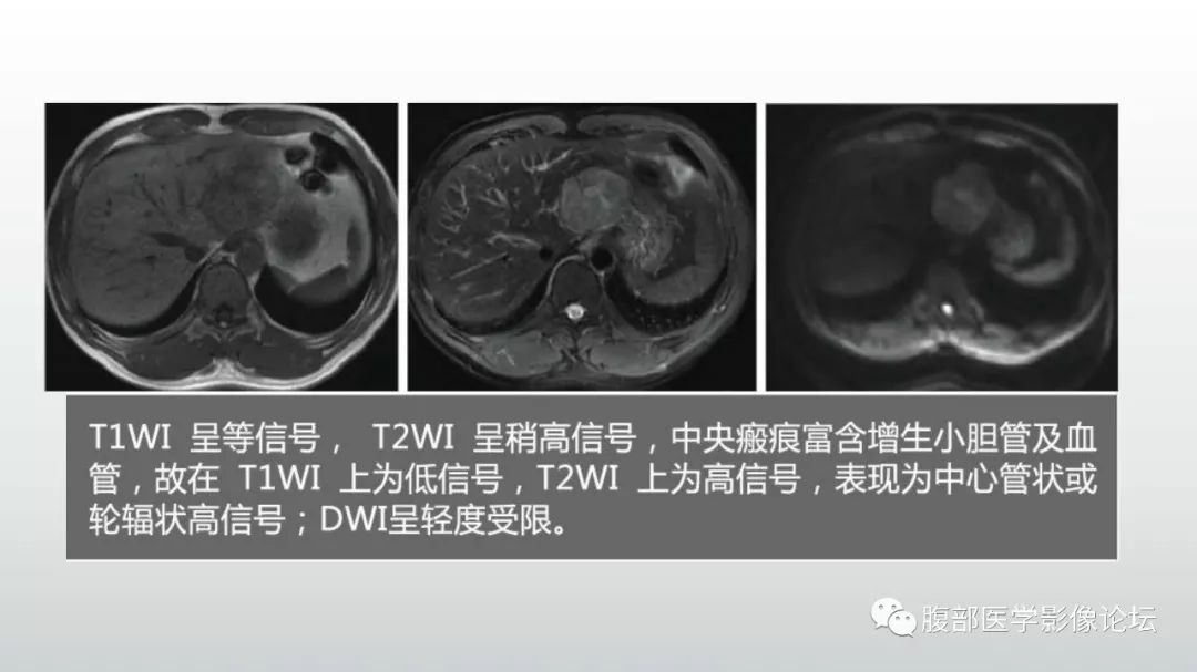 【病例】肝脏血管平滑肌脂肪瘤1例CT及MR影像诊断