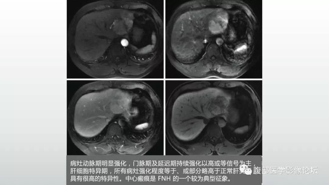 【病例】肝脏血管平滑肌脂肪瘤1例CT及MR影像诊断