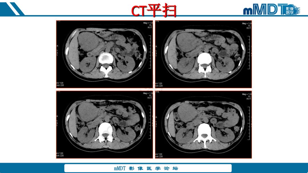 【病例】腹腔炎性肌纤维母细胞瘤1例CT病例读片分析