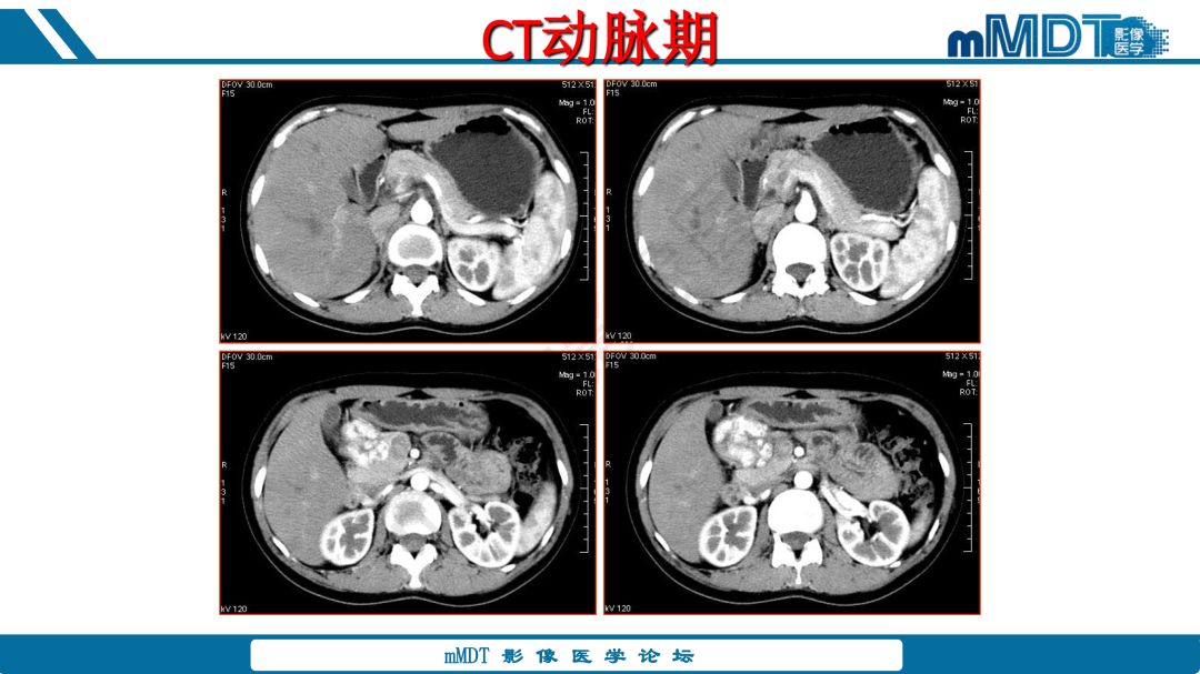 【病例】腹腔炎性肌纤维母细胞瘤1例CT病例读片分析