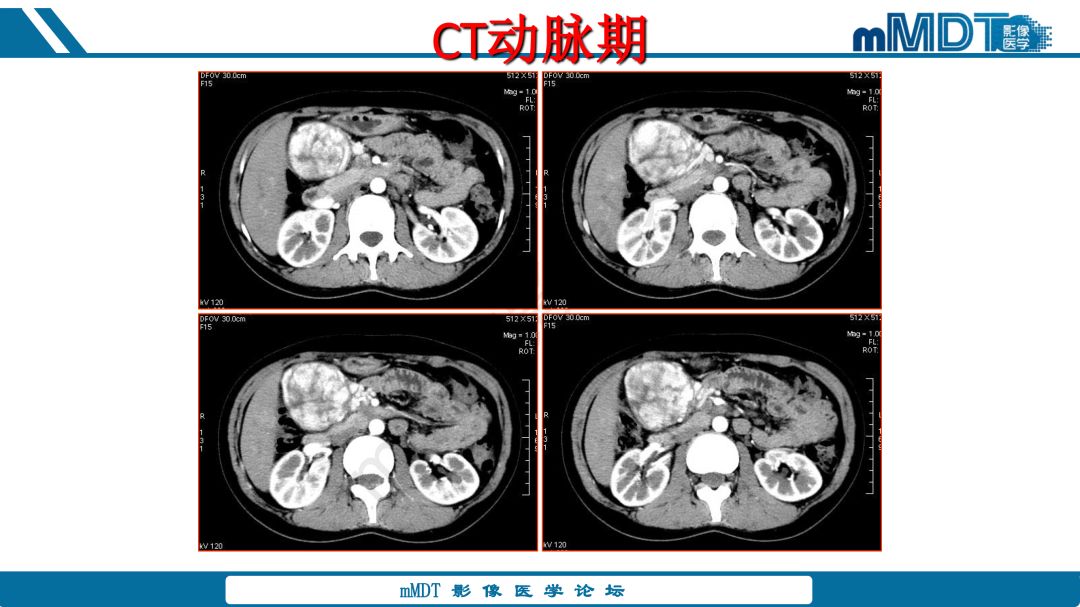 【病例】腹腔炎性肌纤维母细胞瘤1例CT病例读片分析