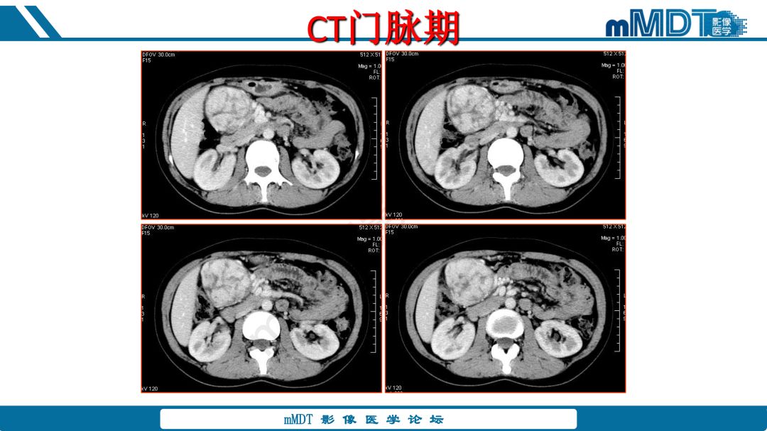 【病例】腹腔炎性肌纤维母细胞瘤1例CT病例读片分析
