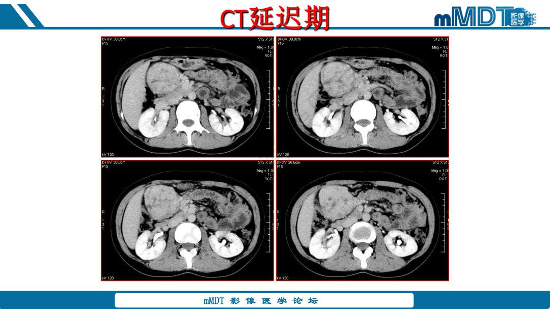 【病例】腹腔炎性肌纤维母细胞瘤1例CT病例读片分析