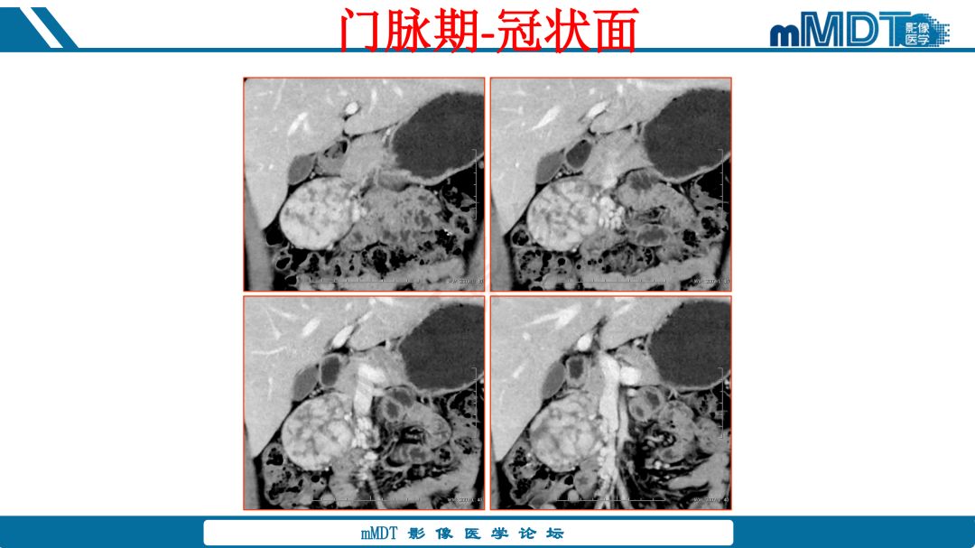 【病例】腹腔炎性肌纤维母细胞瘤1例CT病例读片分析