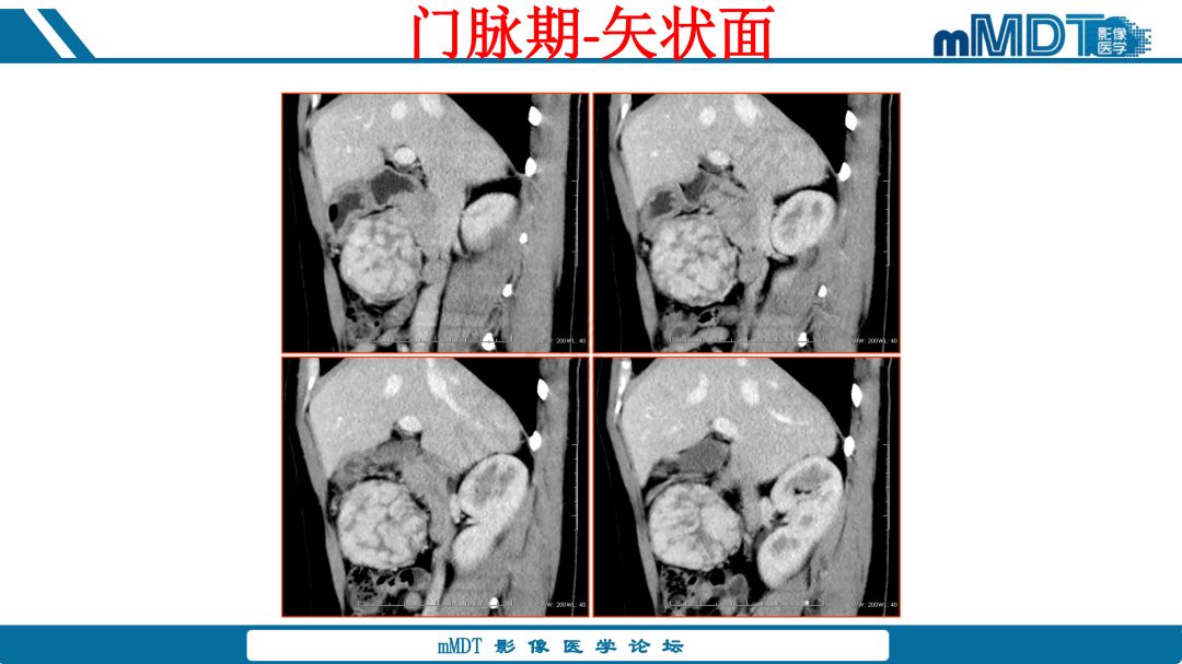 【病例】腹腔炎性肌纤维母细胞瘤1例CT病例读片分析