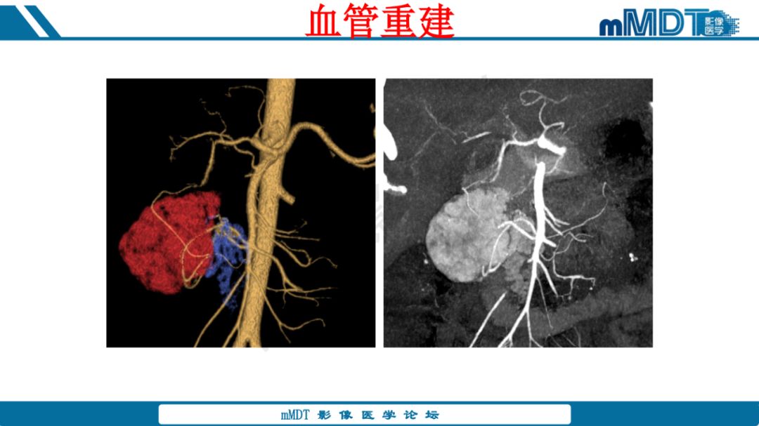 【病例】腹腔炎性肌纤维母细胞瘤1例CT病例读片分析
