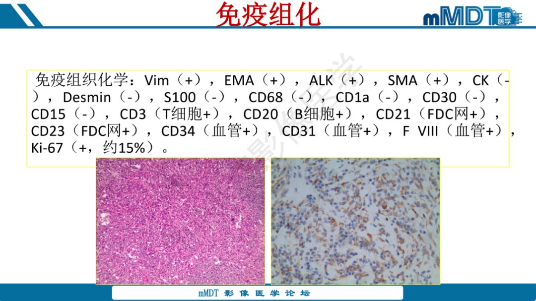 【病例】腹腔炎性肌纤维母细胞瘤1例CT病例读片分析