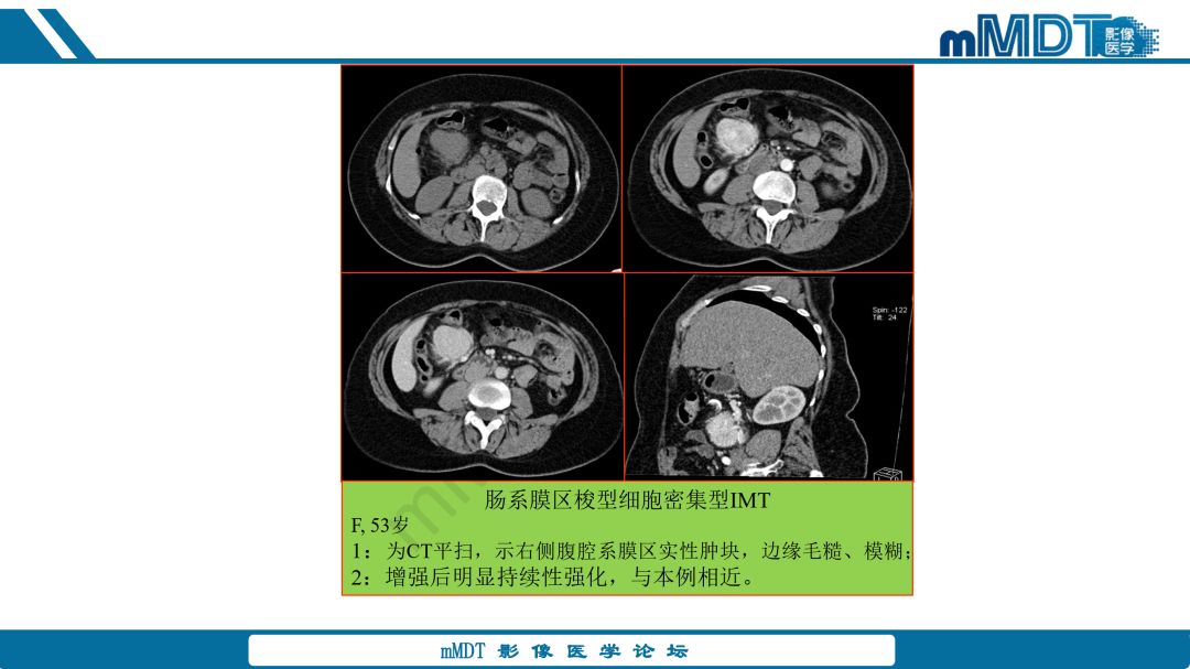 【病例】腹腔炎性肌纤维母细胞瘤1例CT病例读片分析