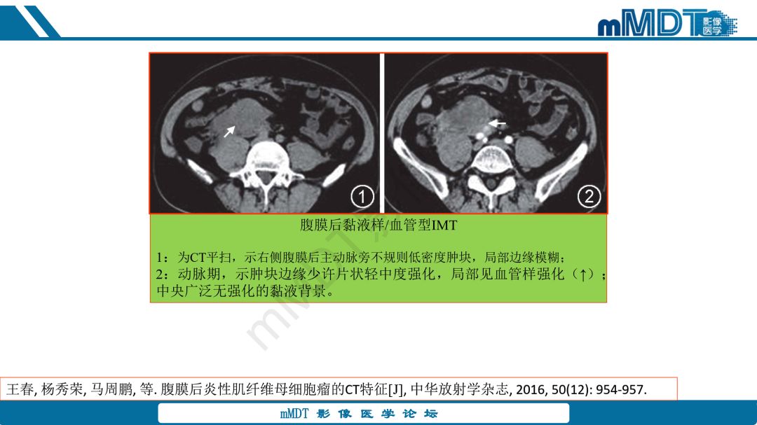 【病例】腹腔炎性肌纤维母细胞瘤1例CT病例读片分析