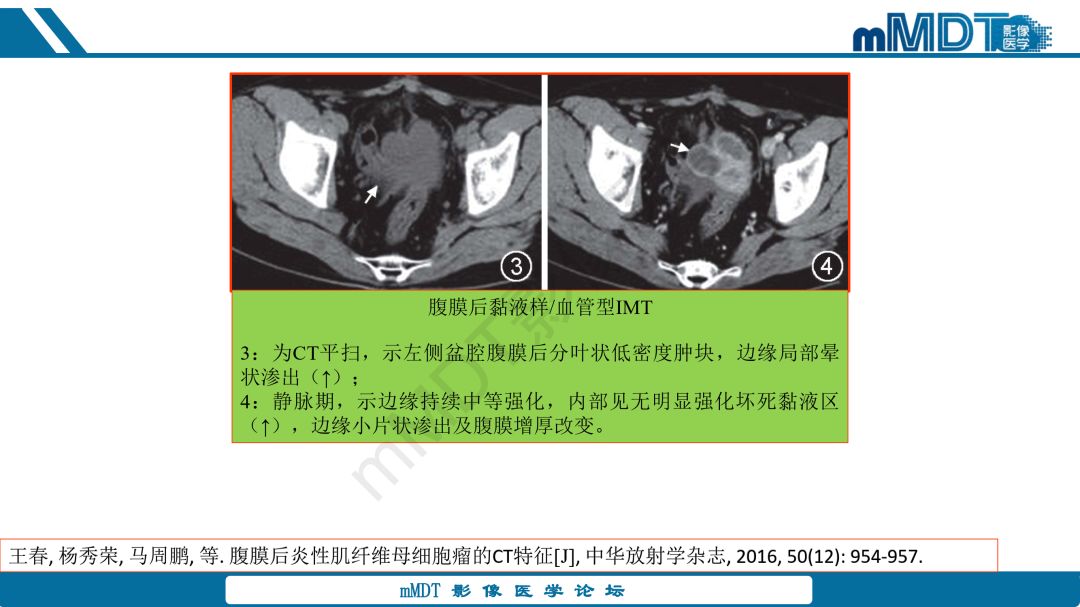 【病例】腹腔炎性肌纤维母细胞瘤1例CT病例读片分析
