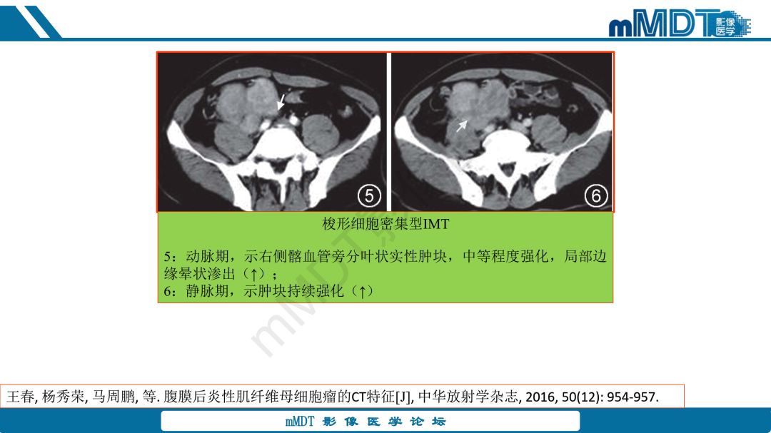 【病例】腹腔炎性肌纤维母细胞瘤1例CT病例读片分析