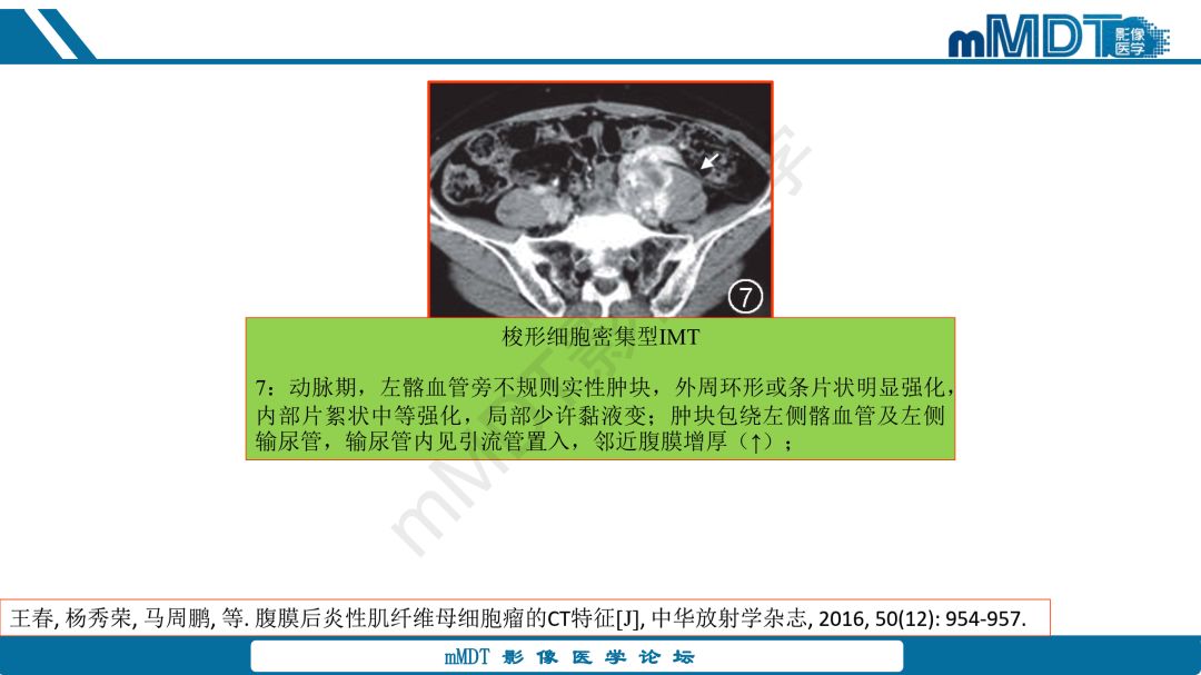 【病例】腹腔炎性肌纤维母细胞瘤1例CT病例读片分析