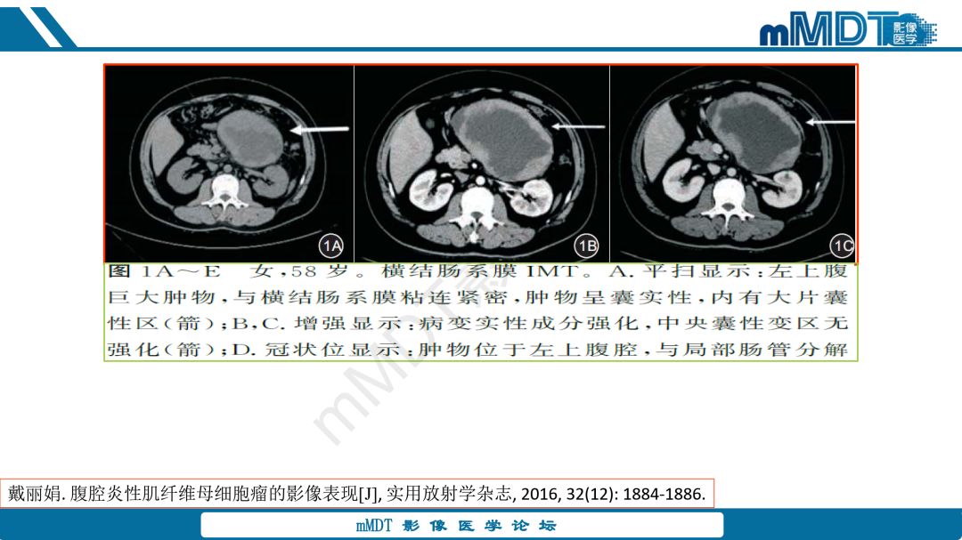 【病例】腹腔炎性肌纤维母细胞瘤1例CT病例读片分析
