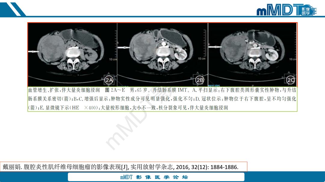 【病例】腹腔炎性肌纤维母细胞瘤1例CT病例读片分析