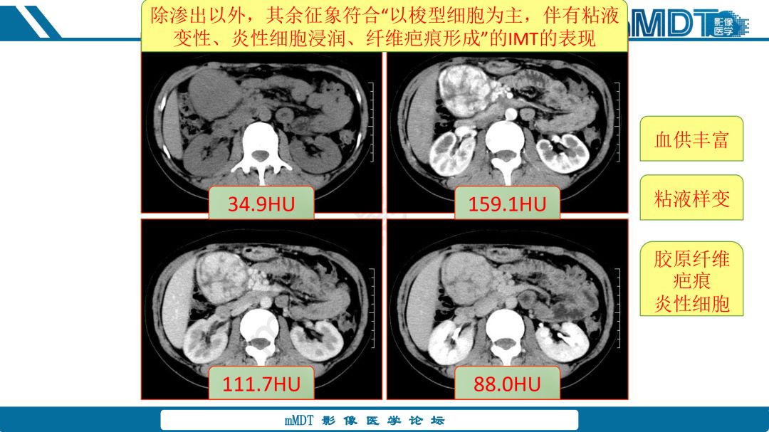 【病例】腹腔炎性肌纤维母细胞瘤1例CT病例读片分析