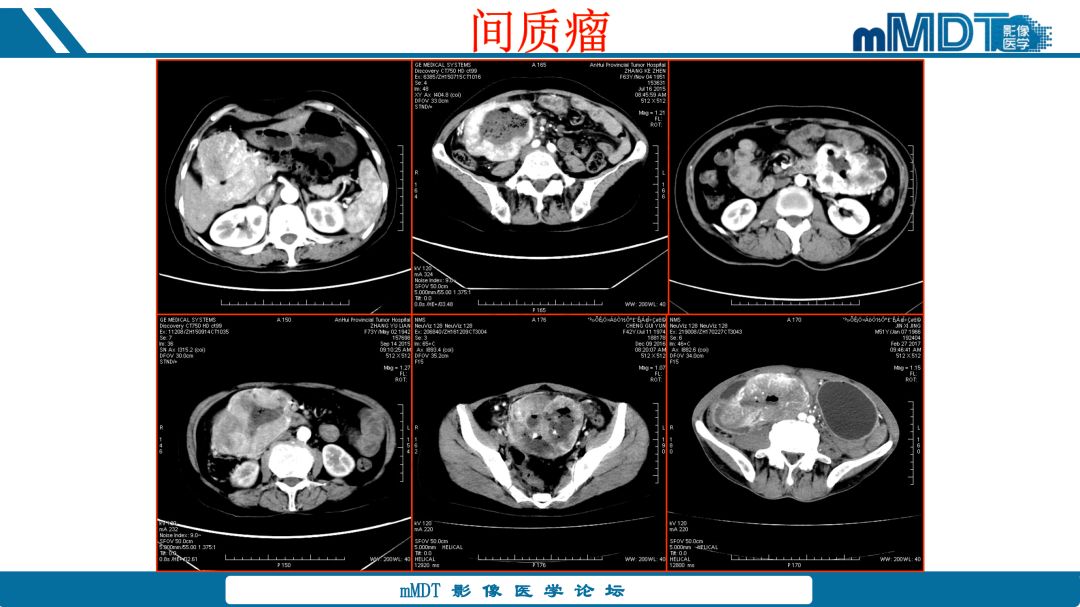 【病例】腹腔炎性肌纤维母细胞瘤1例CT病例读片分析