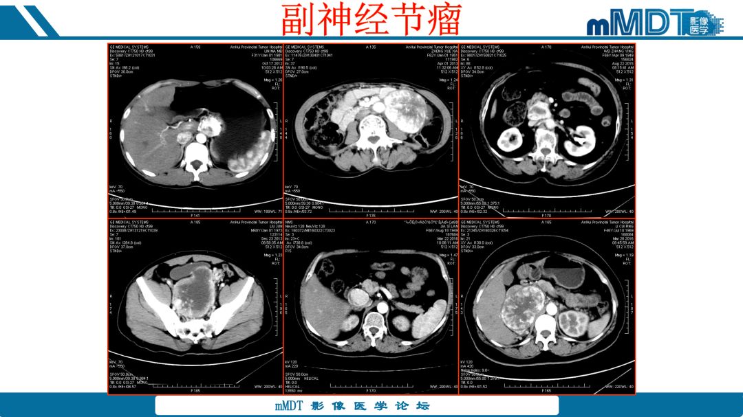 【病例】腹腔炎性肌纤维母细胞瘤1例CT病例读片分析