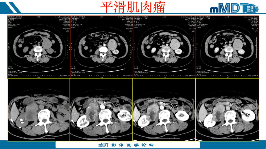 【病例】腹腔炎性肌纤维母细胞瘤1例CT病例读片分析