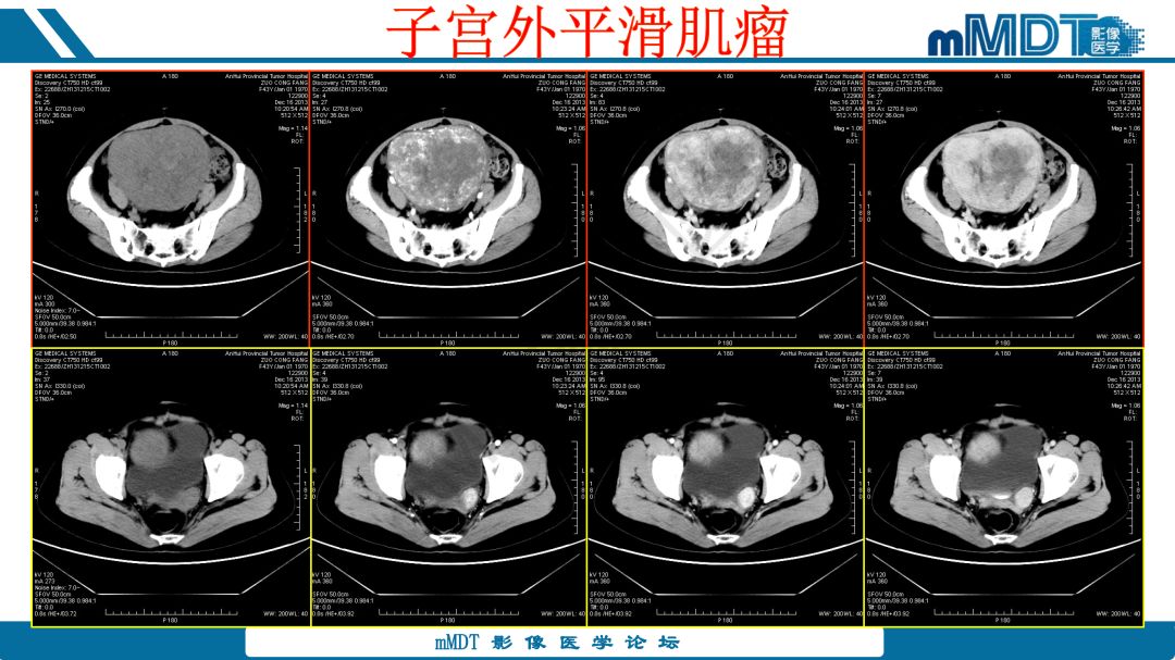【病例】腹腔炎性肌纤维母细胞瘤1例CT病例读片分析