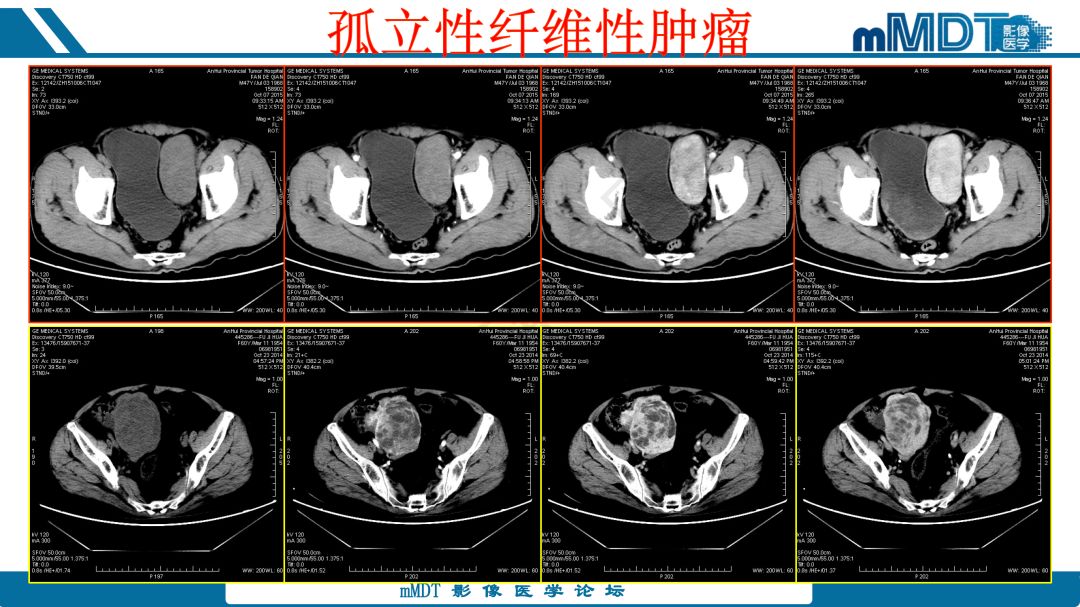 【病例】腹腔炎性肌纤维母细胞瘤1例CT病例读片分析