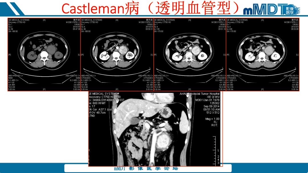 【病例】腹腔炎性肌纤维母细胞瘤1例CT病例读片分析
