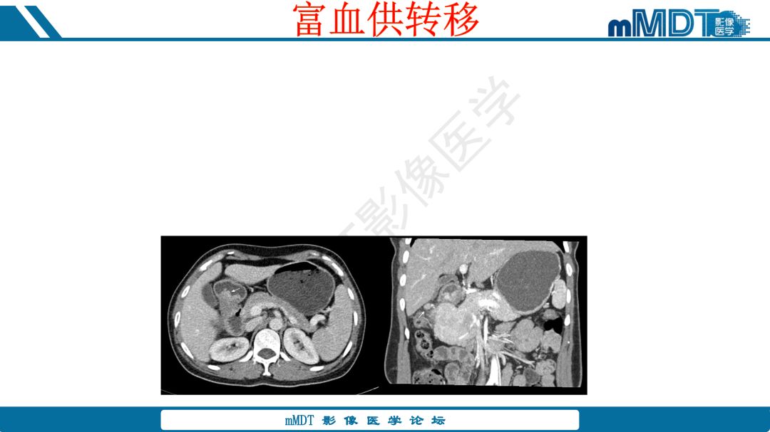 【病例】腹腔炎性肌纤维母细胞瘤1例CT病例读片分析