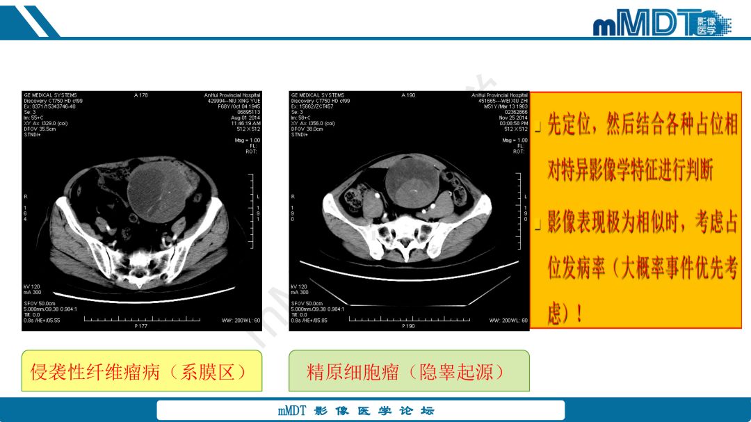 【病例】腹腔炎性肌纤维母细胞瘤1例CT病例读片分析
