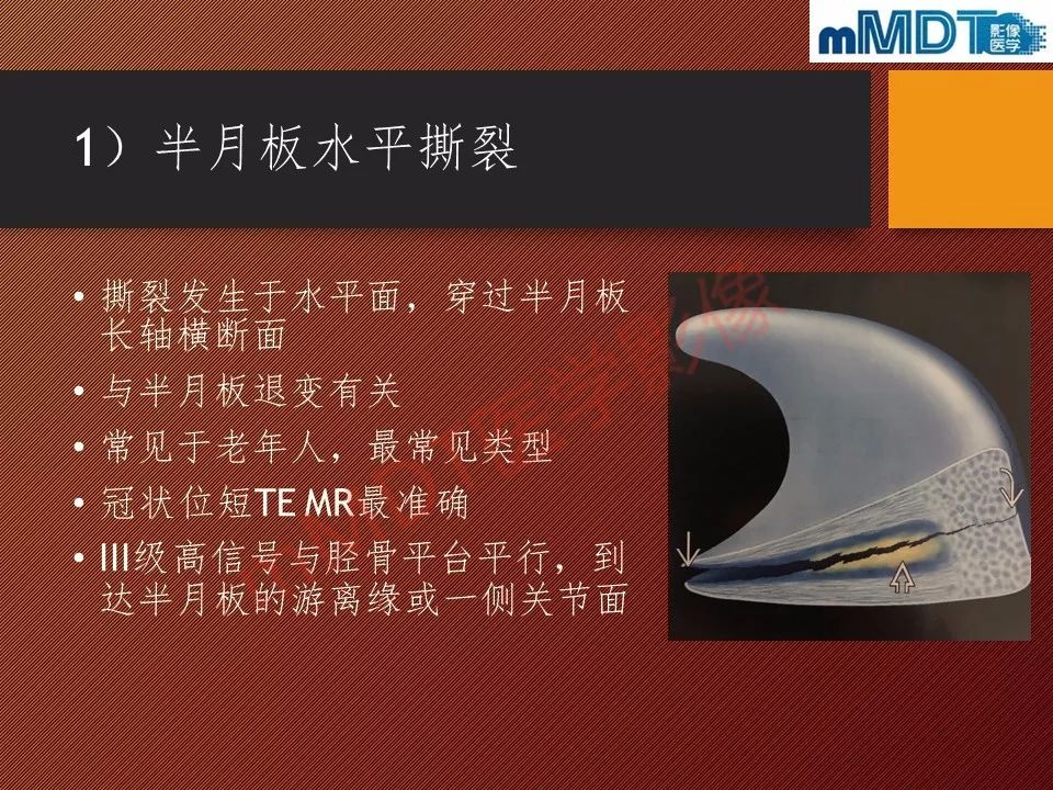 【PPT】半月板撕裂分型的MR诊断