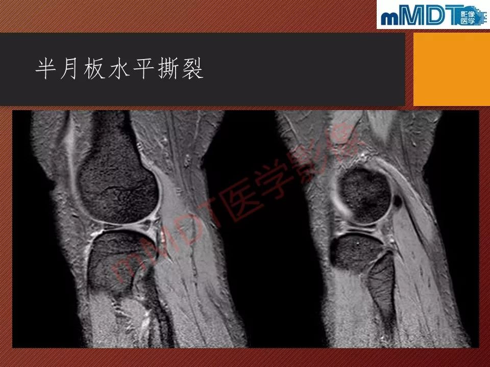 【PPT】半月板撕裂分型的MR诊断