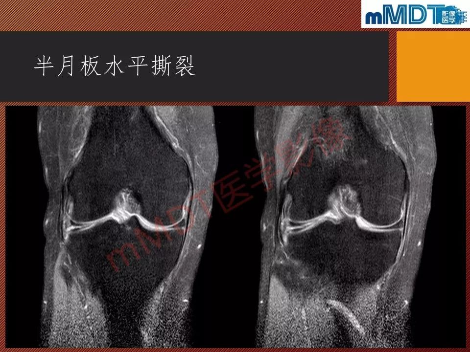 【PPT】半月板撕裂分型的MR诊断