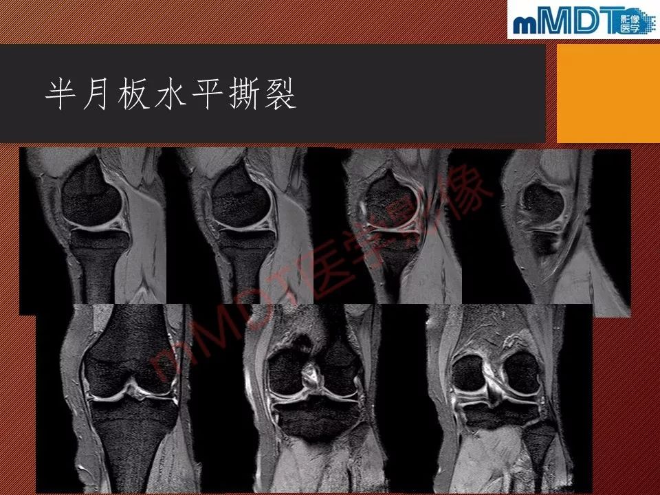 【PPT】半月板撕裂分型的MR诊断