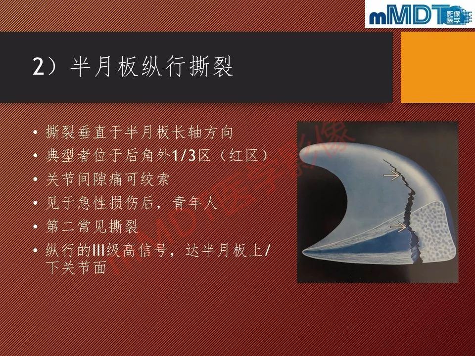 【PPT】半月板撕裂分型的MR诊断