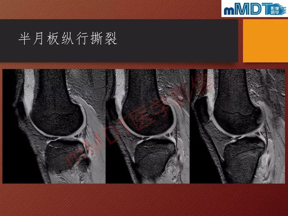 【PPT】半月板撕裂分型的MR诊断