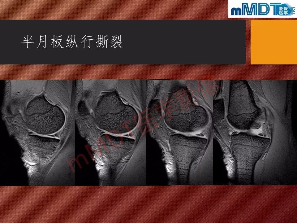 【PPT】半月板撕裂分型的MR诊断