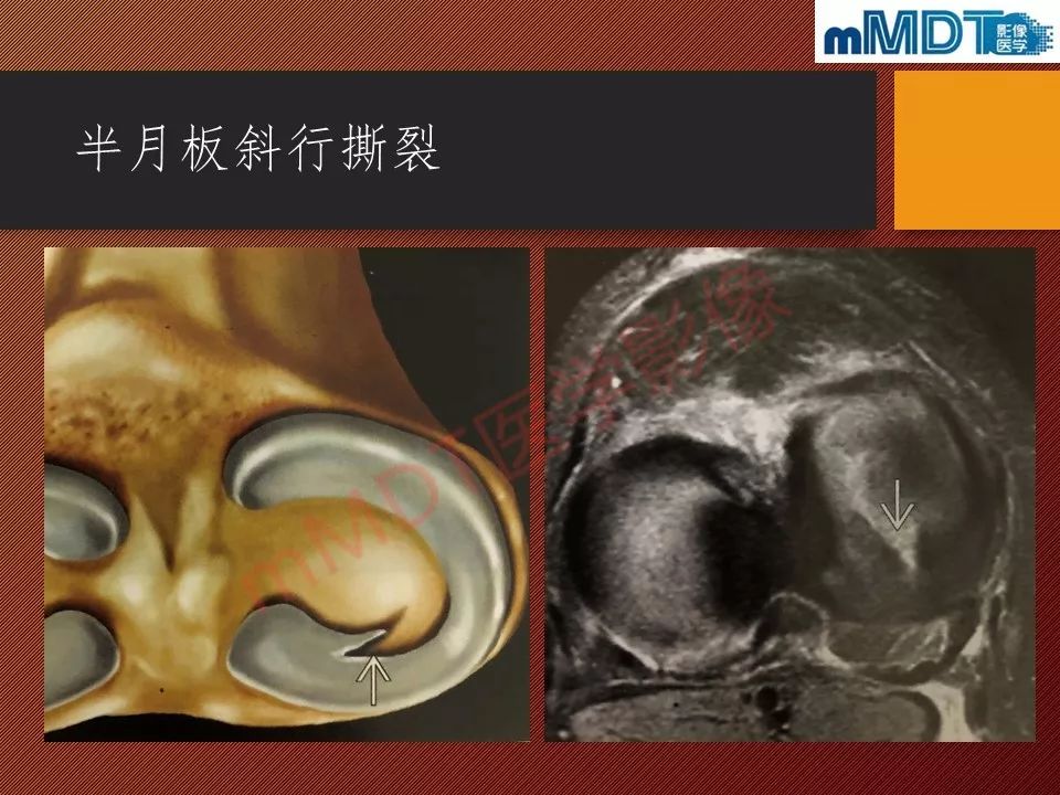 【PPT】半月板撕裂分型的MR诊断