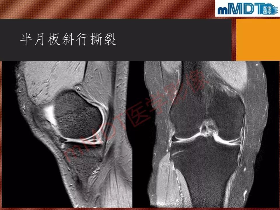 【PPT】半月板撕裂分型的MR诊断