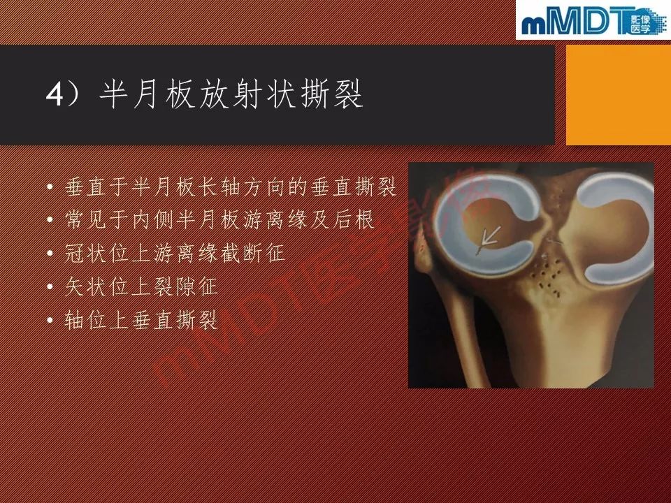 【PPT】半月板撕裂分型的MR诊断