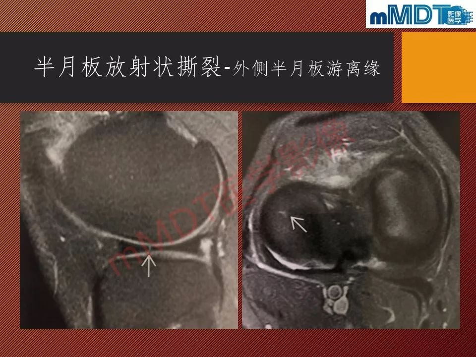 【PPT】半月板撕裂分型的MR诊断