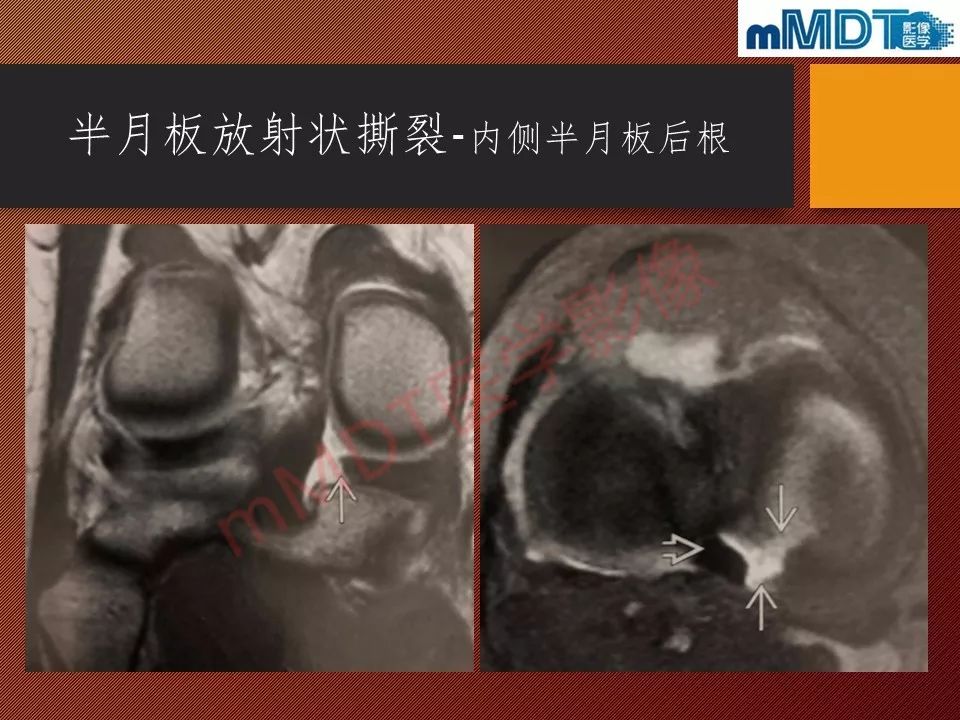 【PPT】半月板撕裂分型的MR诊断