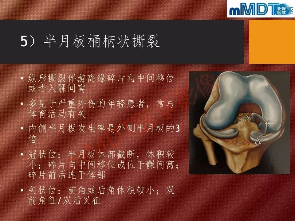 【PPT】半月板撕裂分型的MR诊断