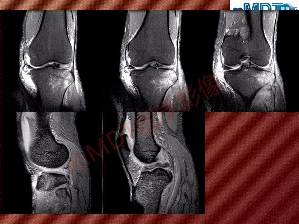 【PPT】半月板撕裂分型的MR诊断